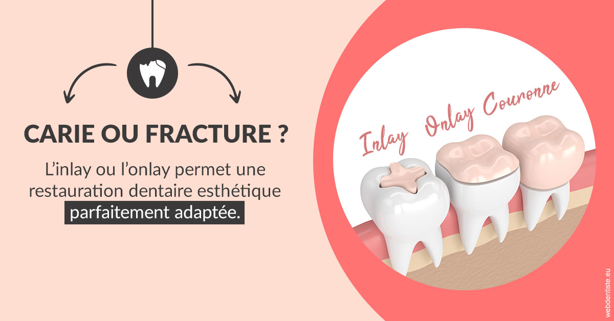 https://selarl-dentiste-drs-aouizerate.chirurgiens-dentistes.fr/T2 2023 - Carie ou fracture 2