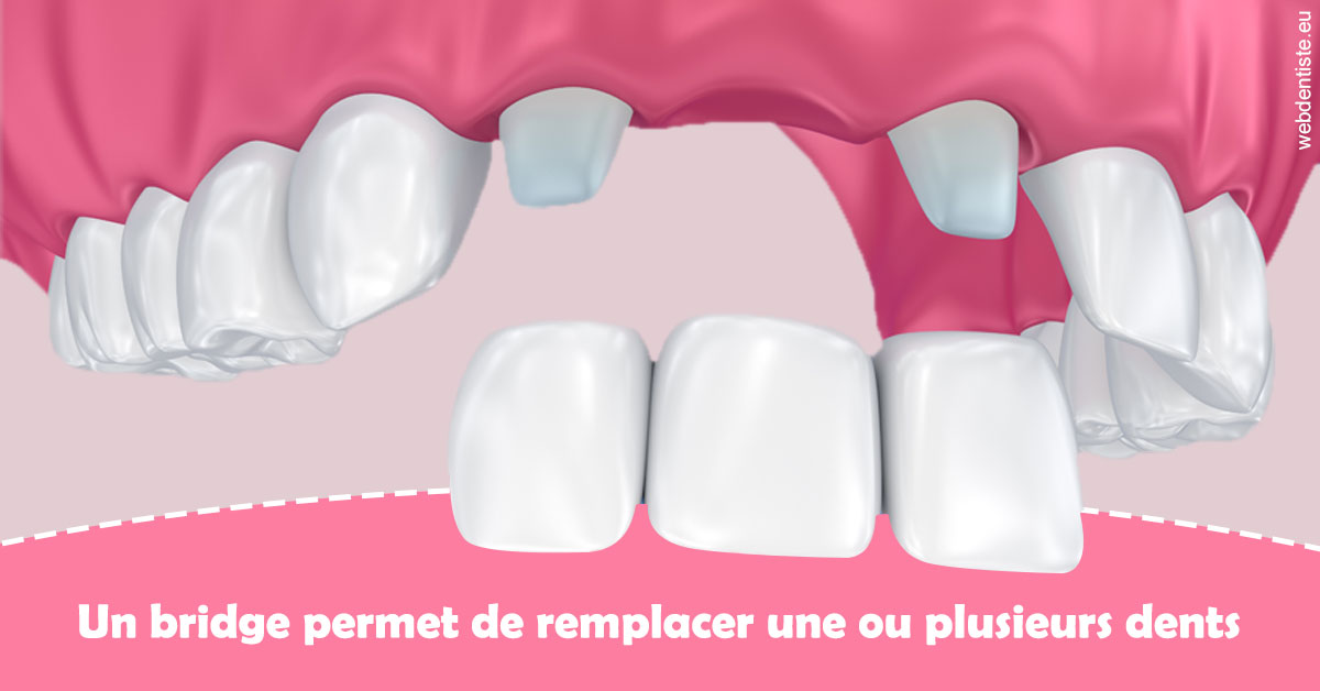 https://selarl-dentiste-drs-aouizerate.chirurgiens-dentistes.fr/Bridge remplacer dents 2