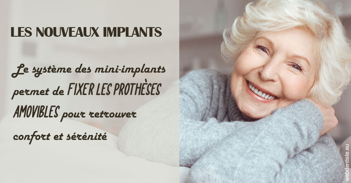 https://selarl-dentiste-drs-aouizerate.chirurgiens-dentistes.fr/Les nouveaux implants 1