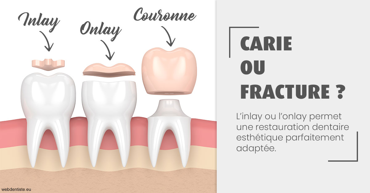 https://selarl-dentiste-drs-aouizerate.chirurgiens-dentistes.fr/T2 2023 - Carie ou fracture 1