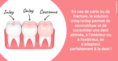 https://selarl-dentiste-drs-aouizerate.chirurgiens-dentistes.fr/L'INLAY ou l'ONLAY 2
