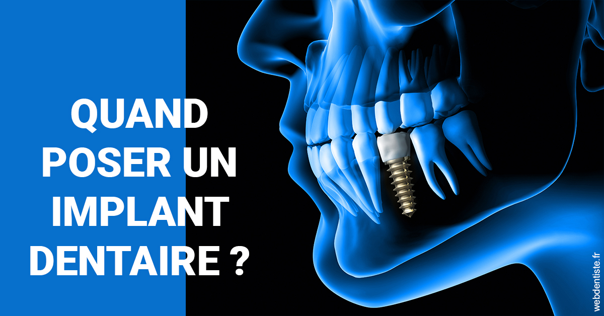 https://selarl-dentiste-drs-aouizerate.chirurgiens-dentistes.fr/Les implants 1