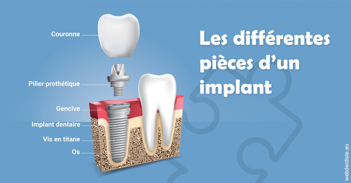 https://selarl-dentiste-drs-aouizerate.chirurgiens-dentistes.fr/Les différentes pièces d’un implant 1