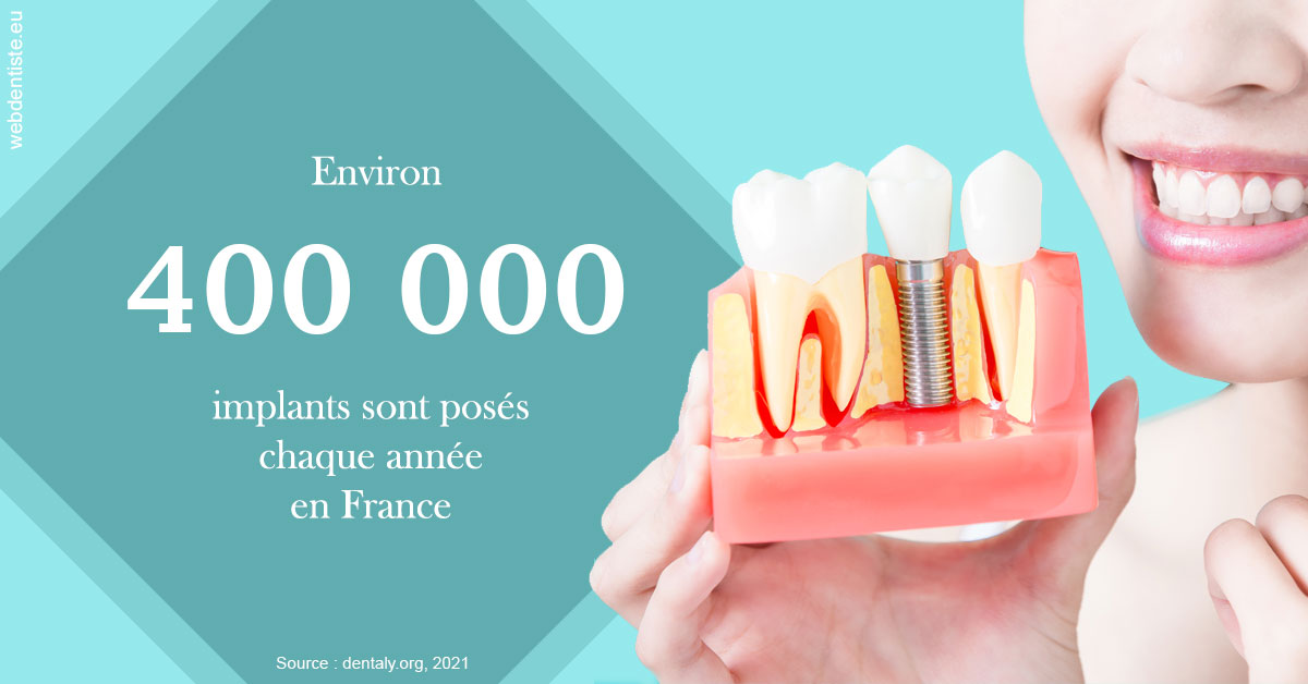 https://selarl-dentiste-drs-aouizerate.chirurgiens-dentistes.fr/Pose d'implants en France 2